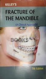 Load image into Gallery viewer, Killeys Fracture of the Mandible