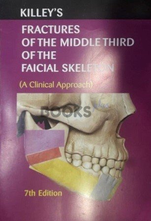 Killeys Fracture of the Middle Third of the Facial Skeleton